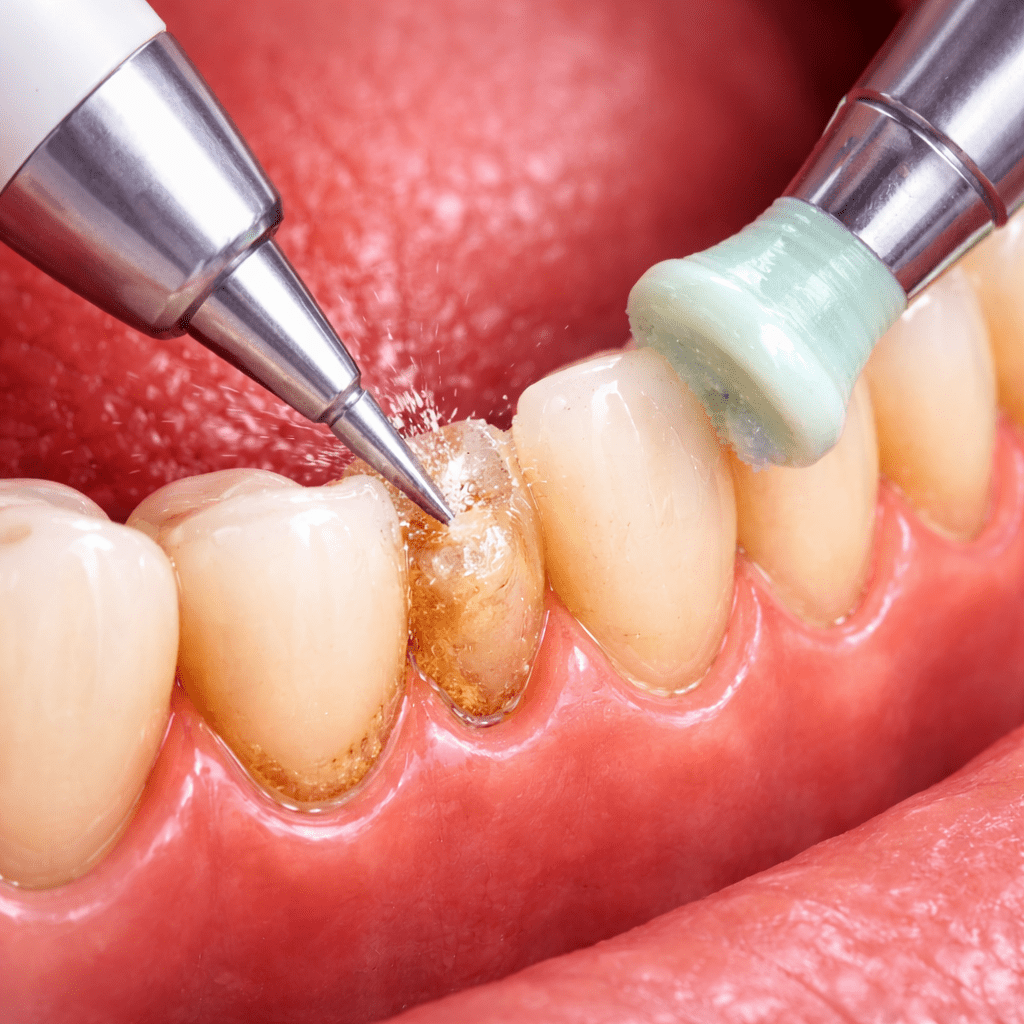 جرم‌گیری دندان با بیمه در شهرک راه‌آهن | کلینیک دندانپزشکی ماه سیما