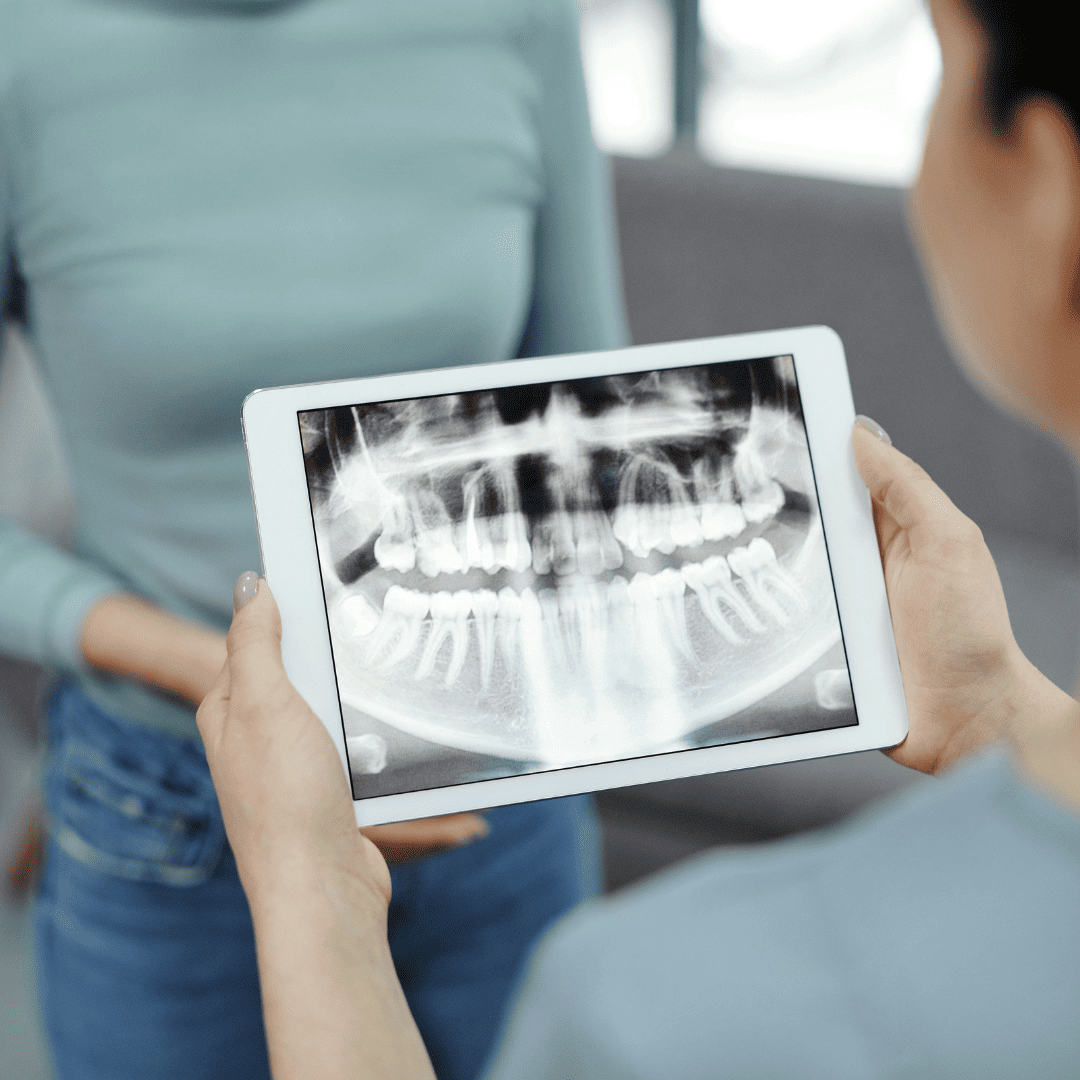  مقایسه ترمیم آمالگام و کامپوزیت