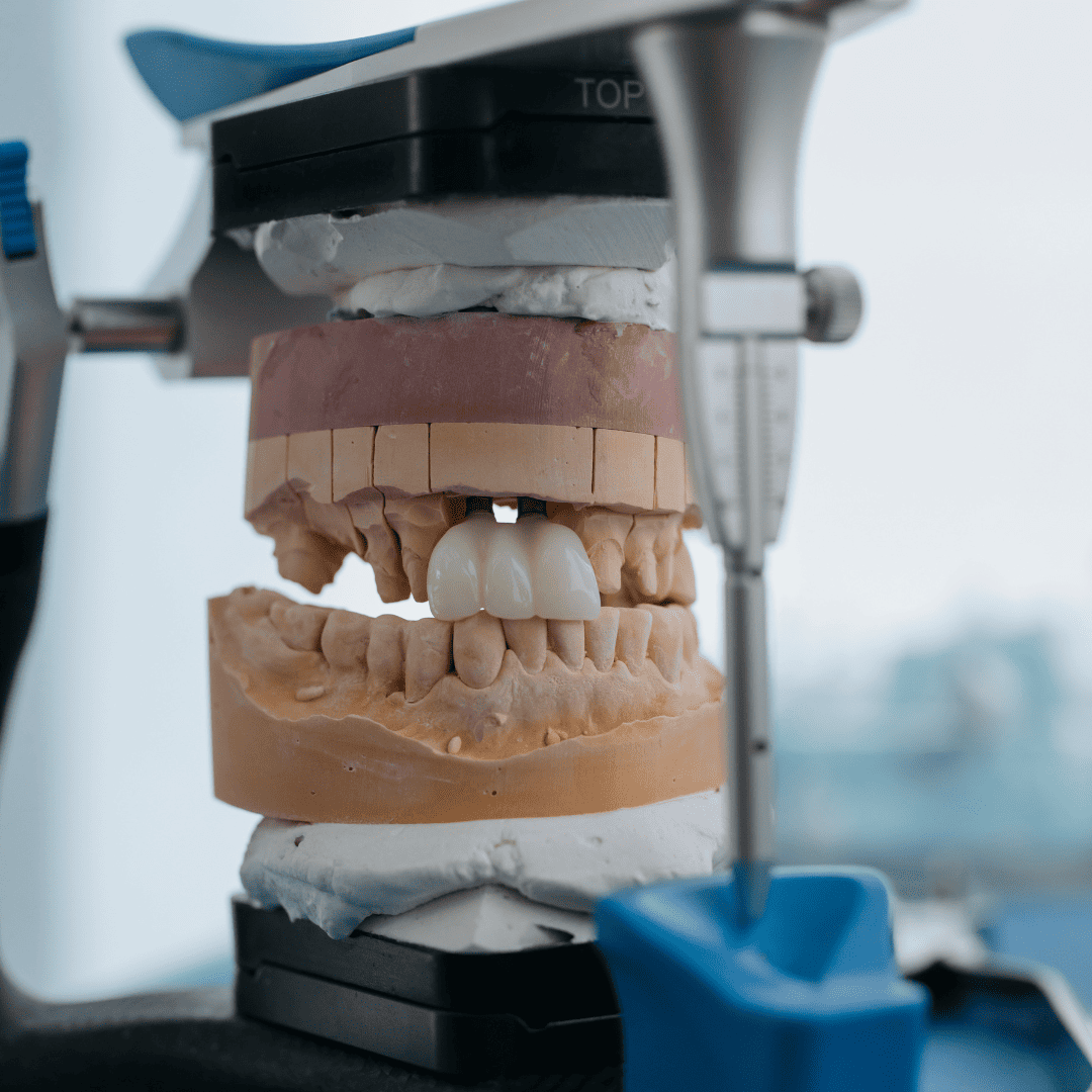 پست و روکش دندان در کلینیک دندانپزشکی ماه سیما